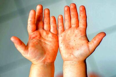 علامت این بیماری مرگبار روی دست ها ظاهر می شود