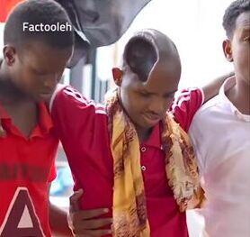 ویدئویی باورنکردنی از مرد سومالیایی که با نصف مغزش زندگی می کند/ بیچاره چه بلایی سرش اومده