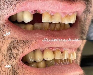 ایمپلنت یک روزه جایگزین سریع بی دندانی