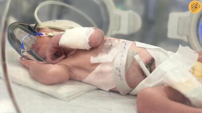 (تصاویر) وضعیت نوزادی که از شکم مادر مرده‌اش متولد شد