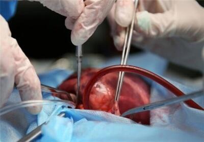 موفقیت پزشکان ایرانی در اولین عمل پیوند اعضا پس از ایست کامل قلبی