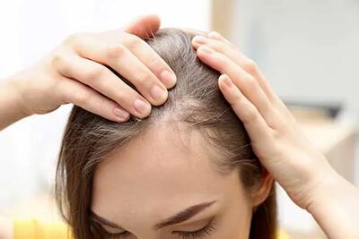 چند روش برای درمان ریزش موی زنان و دختران جوان
