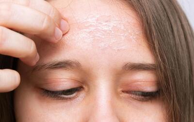 دلایل اصلی ایجاد سبوم یا غدد چربی روی پوست و کف سر