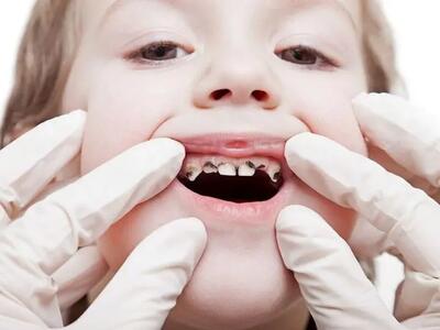 چرا پوسیدگی دندان در بین دانش‌آموزان رایج است؟