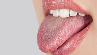 درمان خانگی خشک شدن دهان با چند راهکار ساده