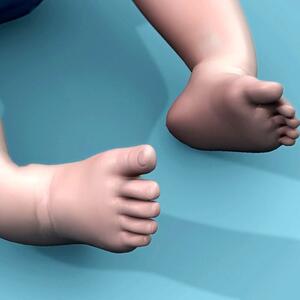 تشخیص پای پرانتزی در کودکان، علت و درمان