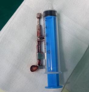 ابزار ۱۳ سانتی دندانپزشکی در معده دختر ۲۰ ساله در ساوه