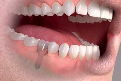 چگونه از ایمپلنت دندان نگهداری کنیم|کلینیک دندانپزشکی دکتر ابوالحسنی