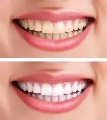 5 شگرد خانگی و طبیعی برای سفید کردن دندان ها + لبخندتان را هالیوودی کنید