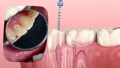 درد دندان بعد از عصب کشی دندان