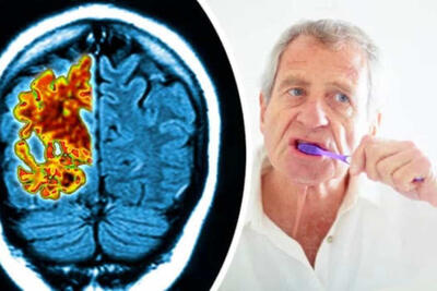 بهداشت نامناسب دهان و دندان اولین نشانه اولیه بیماری آلزایمر