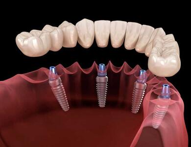 ایمپلنت فوری دندان چیست؟ + مزایا، معایب و مراحل