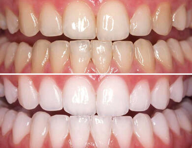 10 روش خانگی سفید کردن دندان ها