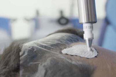 درمان غیرتهاجمی سرطان پوست برای اولین‌بار در ایران