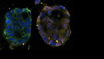 کشف مسیر جدید مرگ سلولی در سرطان: امید تازه برای درمان
