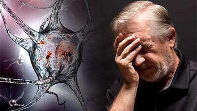 آلزایمر و زوال عقل دیررس چه تفاوتی دارد؟