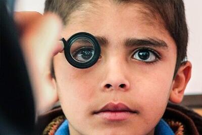 تنبلی چشم یکی از شایع‌ترین علل نابینایی در کودکان است