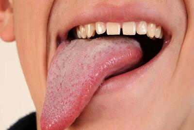 آیا رنگ کبود زبان علامت بیماری خطرناکی است؟ - اندیشه معاصر