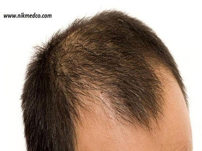 روش های تقویت مو در آقایان و خانم ها