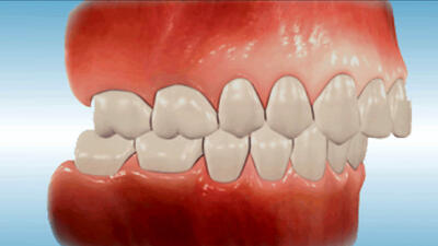 ارتودنسی و لمینت دندان دو راهکار مناسب برای مبارزه با تمام مشکلات فک و دندان