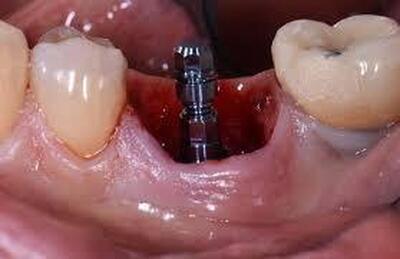 ایمپلنت دندان چند سال عمر می‌کند؟