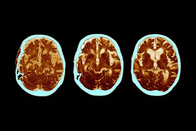 چرا مغز برخی افراد در برابر آلزایمر مقاوم است؟ - زومیت