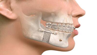 بازسازی فک و صورت با آخرین تکنولوژی شبیه‌سازی عمل جراحی