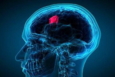 تومورهای مغزی چند نوع هستند؟