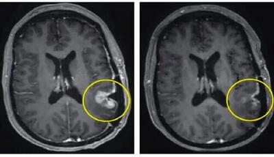 راه‌های تشخیص و درمان انواع تومور مغزی