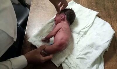 نوزاد شاخ دار متولد شد ! /وضعیت عجیب و ترسناک این بچه همه را شگفت زده کرد +تصاویر
