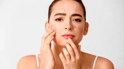 چند درمان خانگی برای رفع فوری جوش‌های صورت
