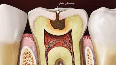 عامل و چگونگی پوسیدگی دندان‌ها + فیلم