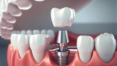 تمام اطلاعات مربوط به هزینه ایمپلنت دندان: آنچه باید بدانید!