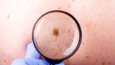 سرطان پوست | شایع‌ترین انواع سرطان پوست کدام است؟