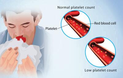 خونریزی بینی نشانه پلاکت پایین در خون است؟