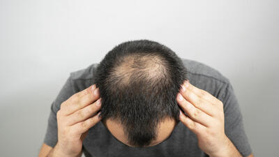 کشف علت اصلی ریزش مو که نویدبخش درمان‌های جدیدی برای طاسی است | خبرگزاری بین المللی شفقنا