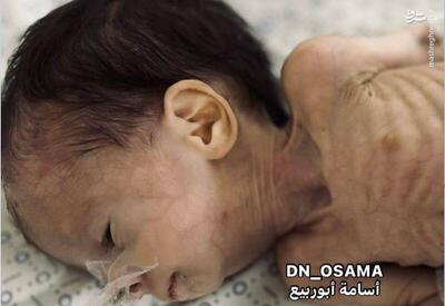 وضعیت اسف‌بار نوزاد فلسطینی به روایت تصویر