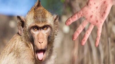 هشدار درباره سویه خطرناک آبله میمونی