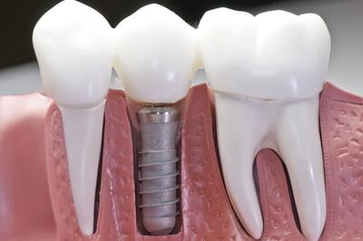 رازهایی که درباره هزینه ایمپلنت دندان نمی دانید!