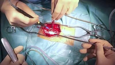 ویدئو| چرا پس از جراحی دیسک کمر همچنان درد داریم؟