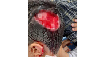 سگ های ولگرد پوست سر پسر 8 ساله را کندند / در شهر سهند رخ داد + عکس