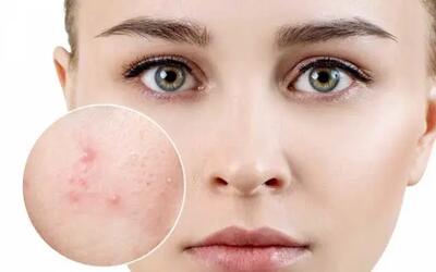 راه‌های موثر برای درمان آکنه پوست: راهنمای جامع و کاربردی