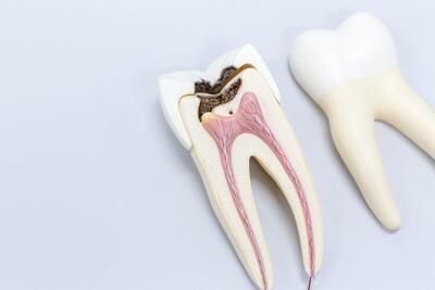 راهنمای کامل کاهش درد عصب دندان