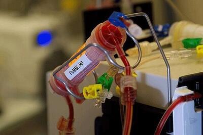 تلاش برای بومی‌سازی انواع سیستم‌های فیلتراسیونی خون