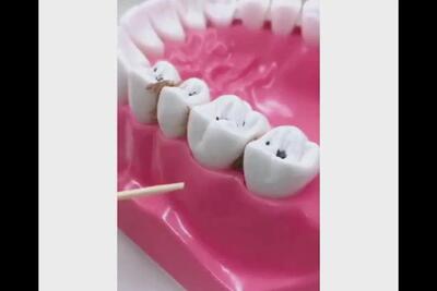 چرا از نخ دندان استفاده کنیم