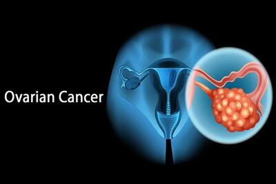 سرطان تخمدان: علائم اولیه و اهمیت تشخیص به موقع