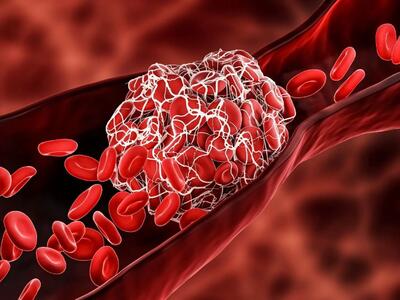 سرطان خون (لوسمی): نشانه‌ها، علل و راه‌های درمانی