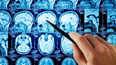 7 نشانه تومور مغزی که یکی از آن خیلی مهم است