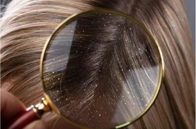 آیا شوره سر برای مو مضر است؟ آیا آب داغ باعث شوره سر می شود؟