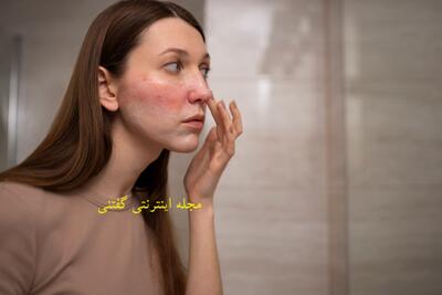 کاهش التهاب پوست در تابستان: اگه پوستت قرمز میشه ببین!